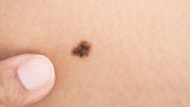 Меланомът и други подобни злокачествени образувания на кожата са най често